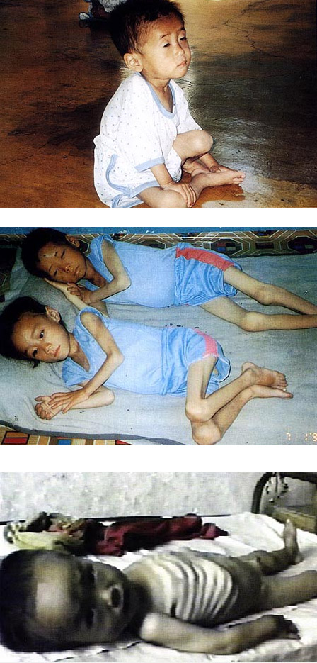 국제구호 단체가 찍은 영양실조로 고통받고 있는 북한 어린이들. 기아에 허덕이는 아프리카 난민 어린이와 다를 바가 없다.