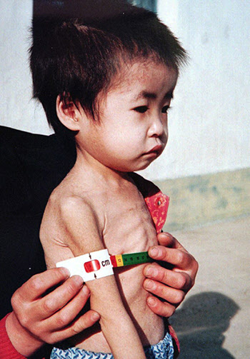 영양실조에 걸린 북한 어린이가 테스트를 받고 있는 모습./유니세프 제공